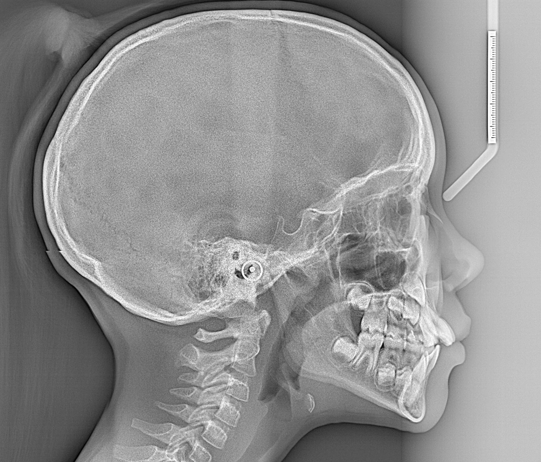 Cephalometric Analysis Based On X ray Scans CephX