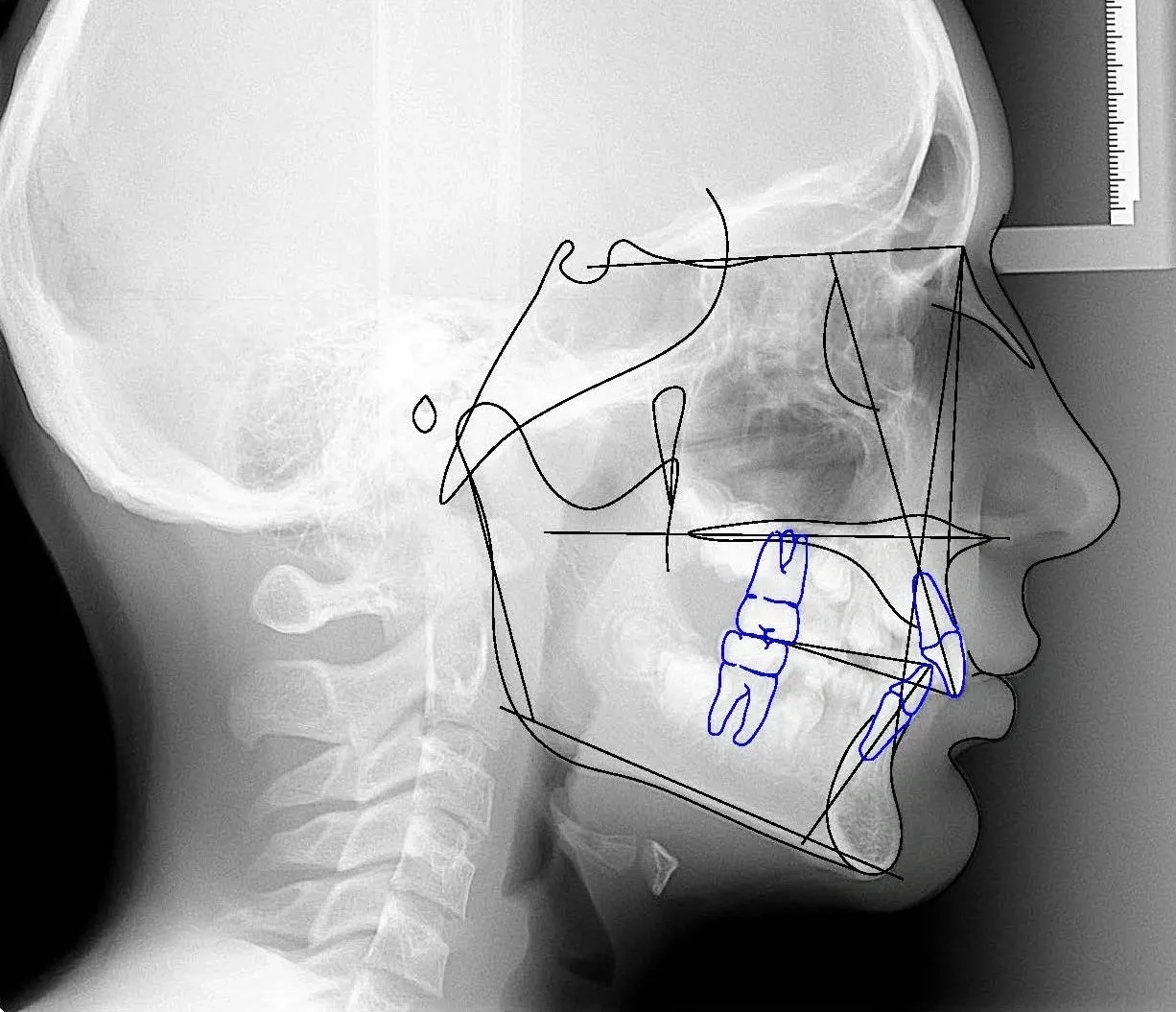 Cephanalysis Ceph Analysis Cephalometric Software