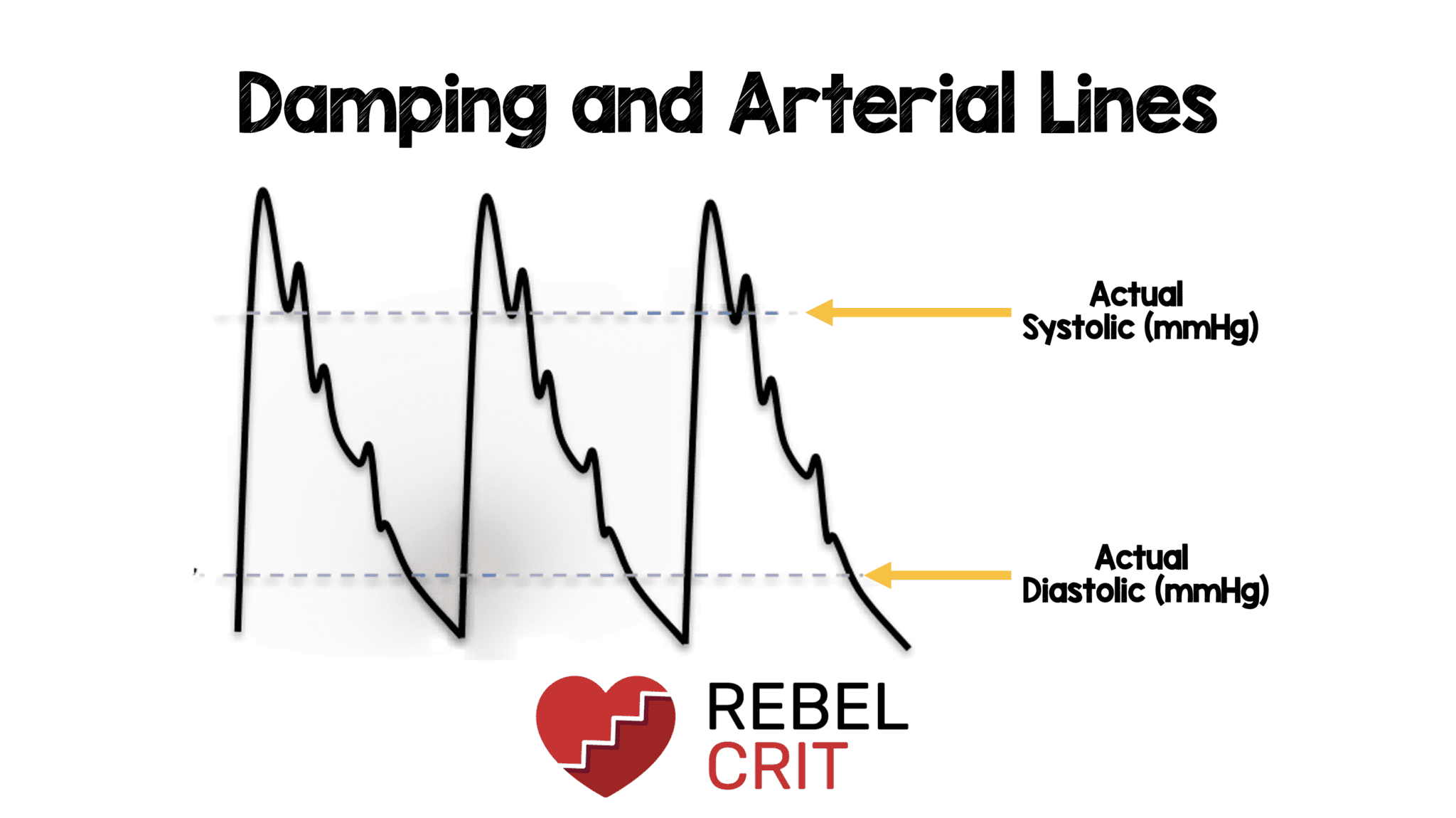 Damping And Arterial Lines REBEL EM Emergency Medicine Blog