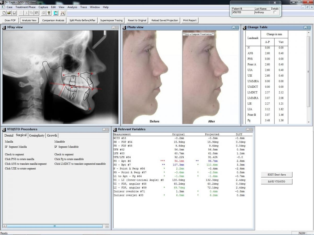 Dr Ceph Cephalometric Analysis Software For Your Imaging 