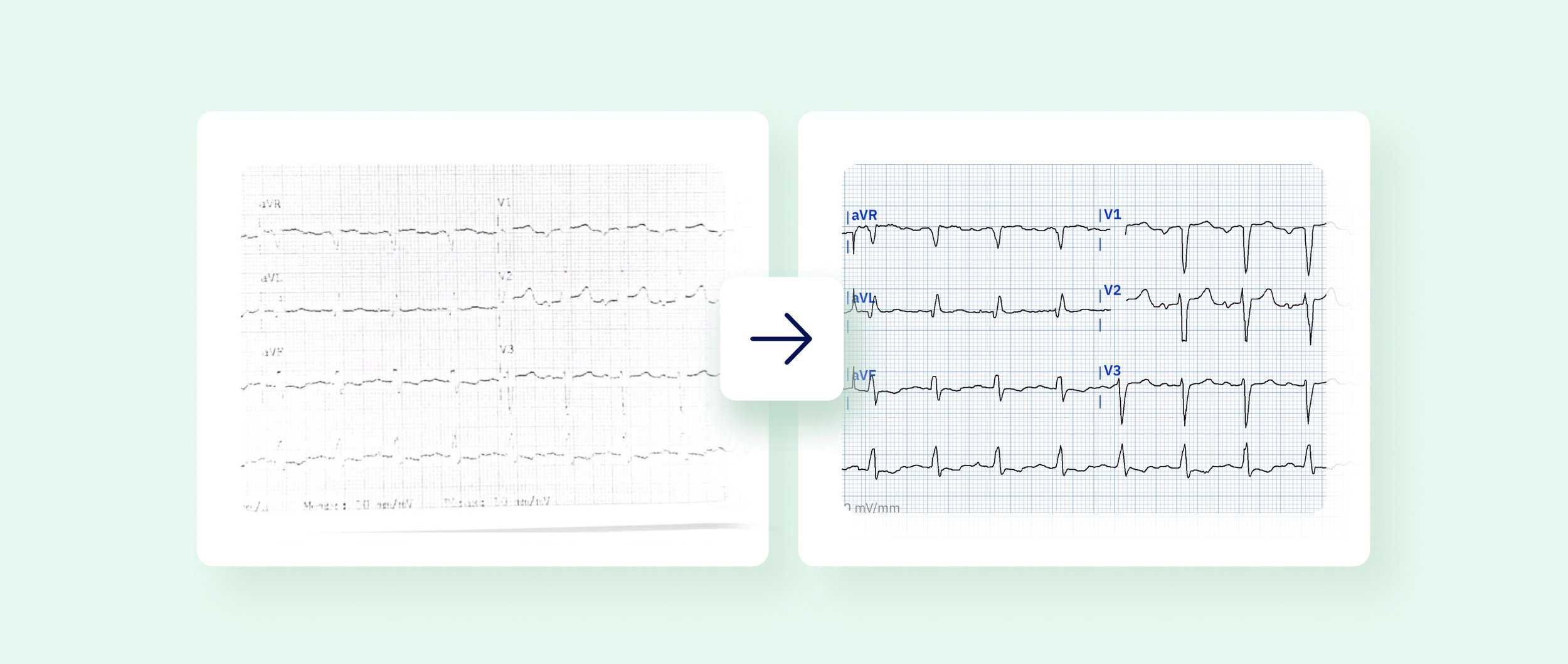 How To Improve The Quality Of An ECG Instantly with Examples 