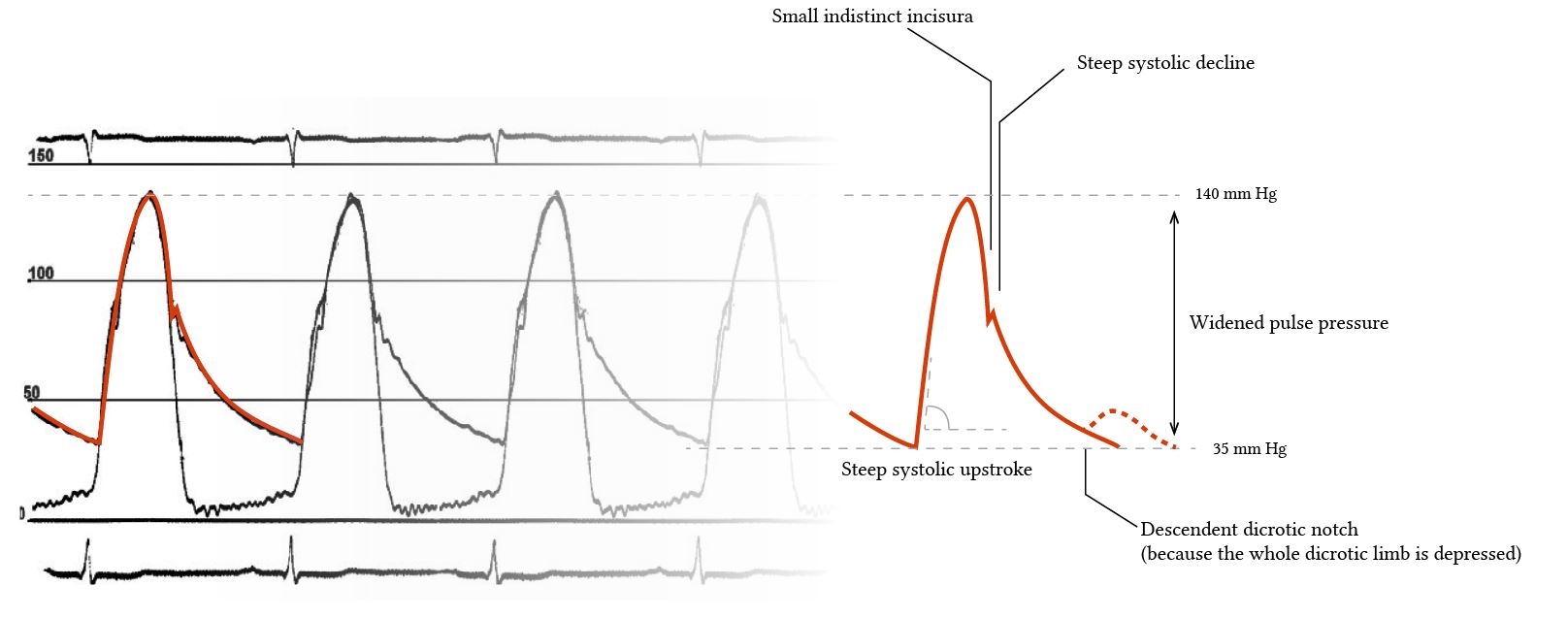 Arterial Line Tracing Interpretation