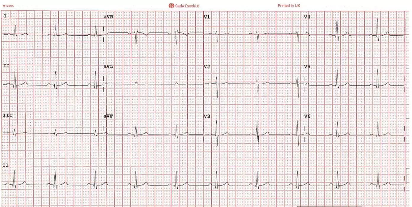 Ecg Tracing Paper