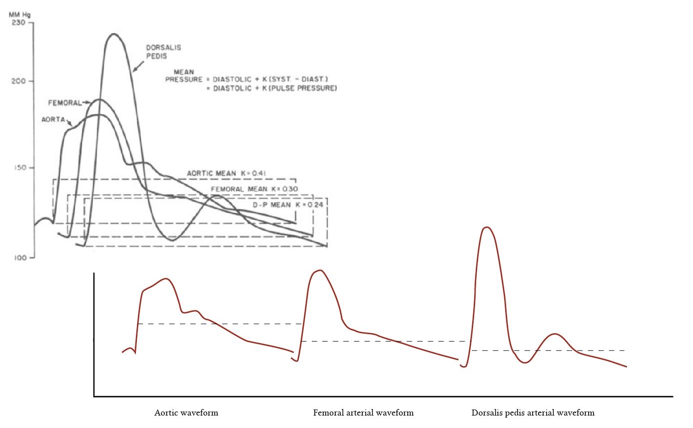 Arterial Line Tracing
