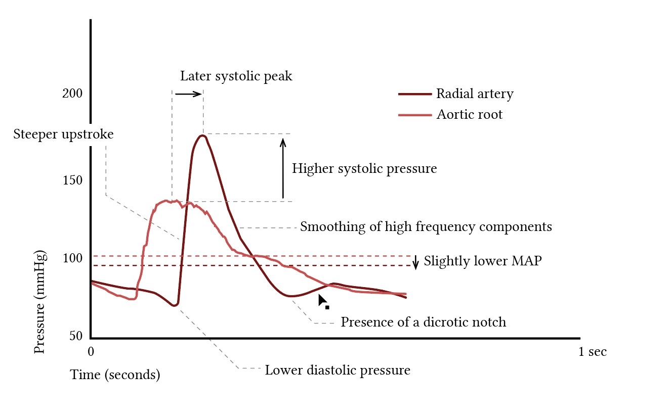 Normal Arterial Line Waveforms Deranged Physiology