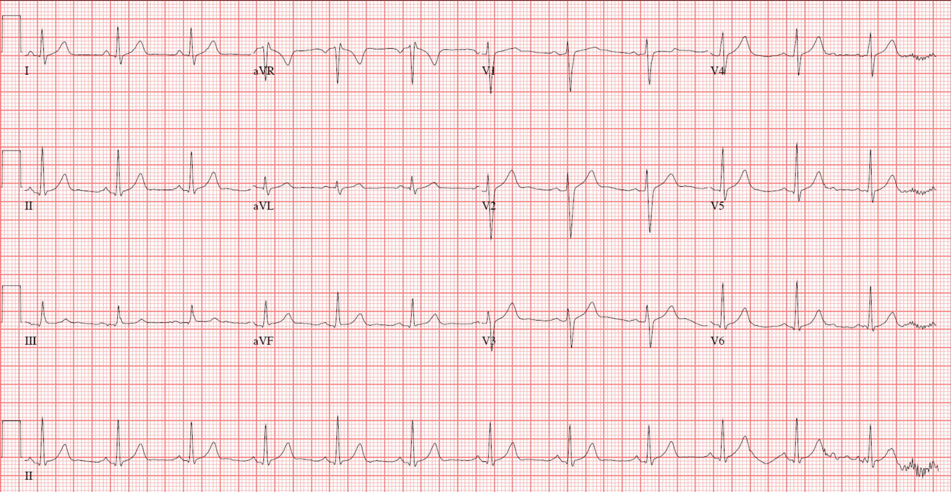 The Normal ECG The Student Physiologist