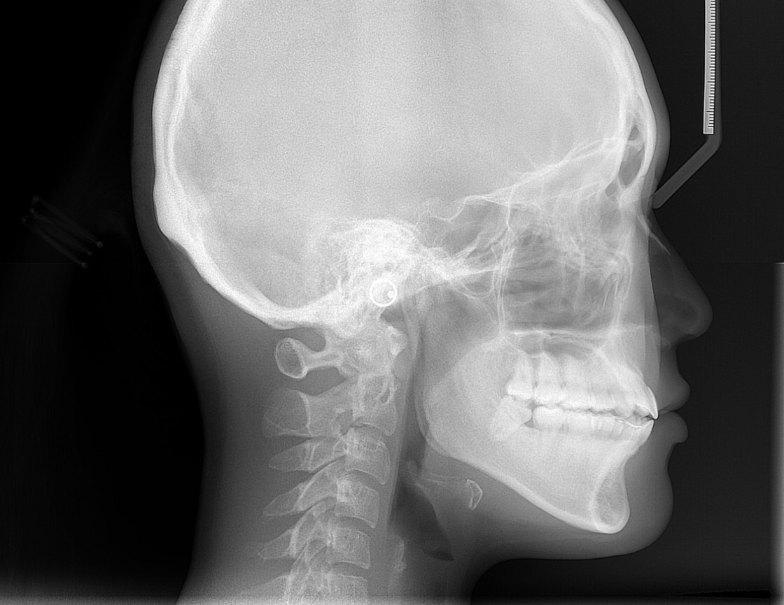 Free Online Cephalometric Tracing