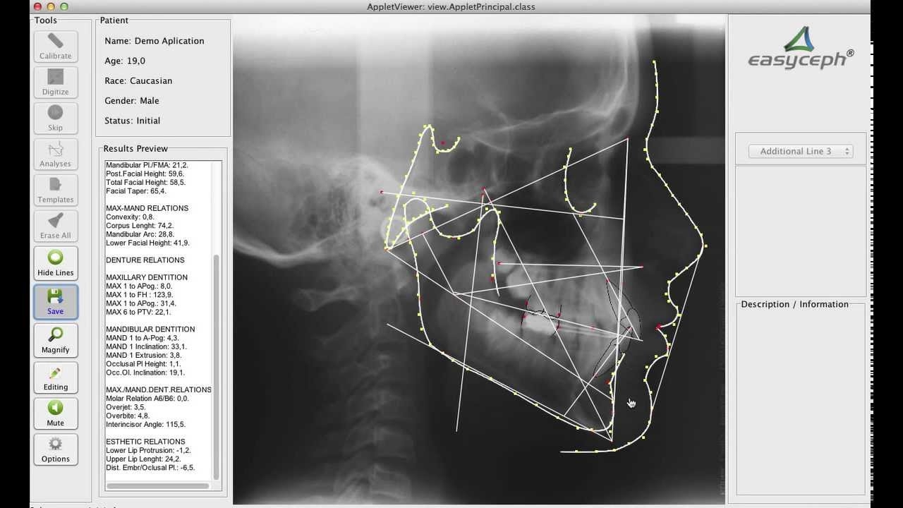 Tutorial 2 Online Lateral Cephalometric Tracing With Easyceph Demo 